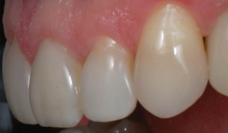 Depois – Facetas Resina