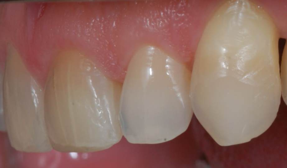 Antes – Facetas Resina