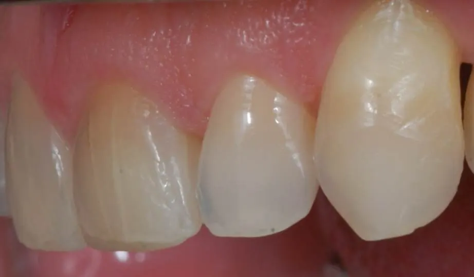 Antes – Facetas Resina
