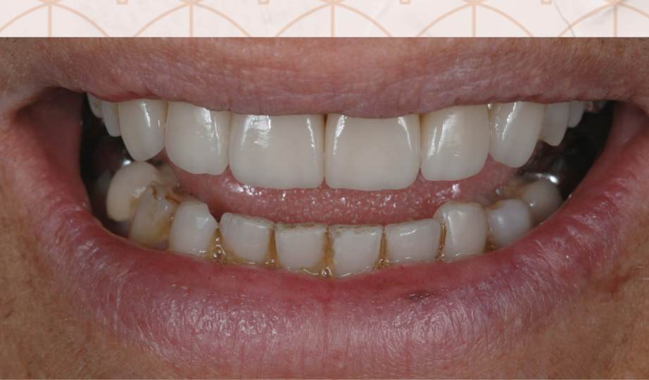 Depois – Facetas Cerâmicas 2