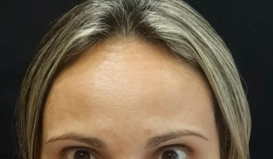 Depois – Harmonização Facial