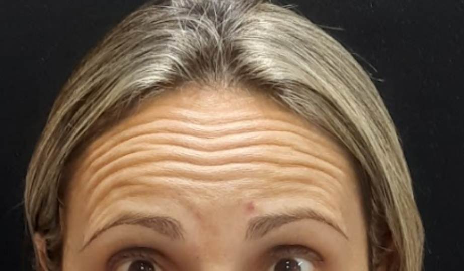 Antes – Harmonização Facial