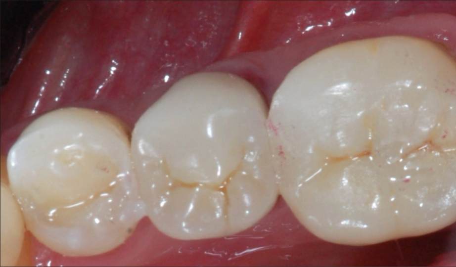 Depois – Onlays/Coroas 1