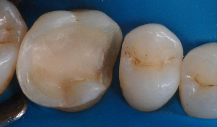 Antes – Onlays/Coroas 2
