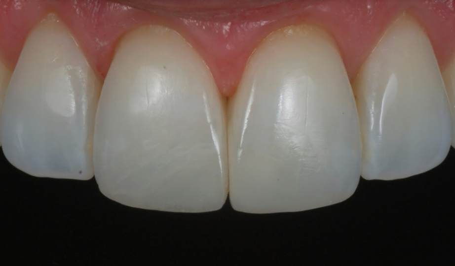 Depois – Resina Anterior