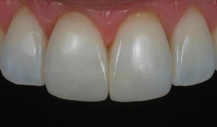Depois – Resina Anterior