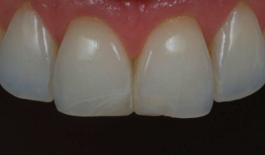 Antes – Resina Anterior