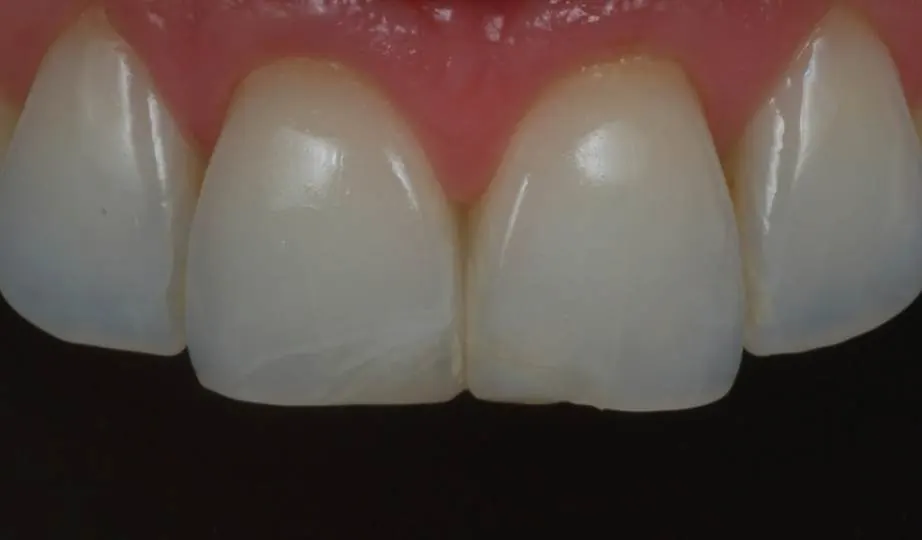 Antes – Resina Anterior