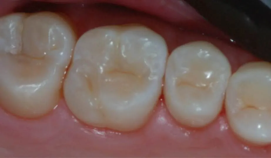 Depois – Resina Posterior