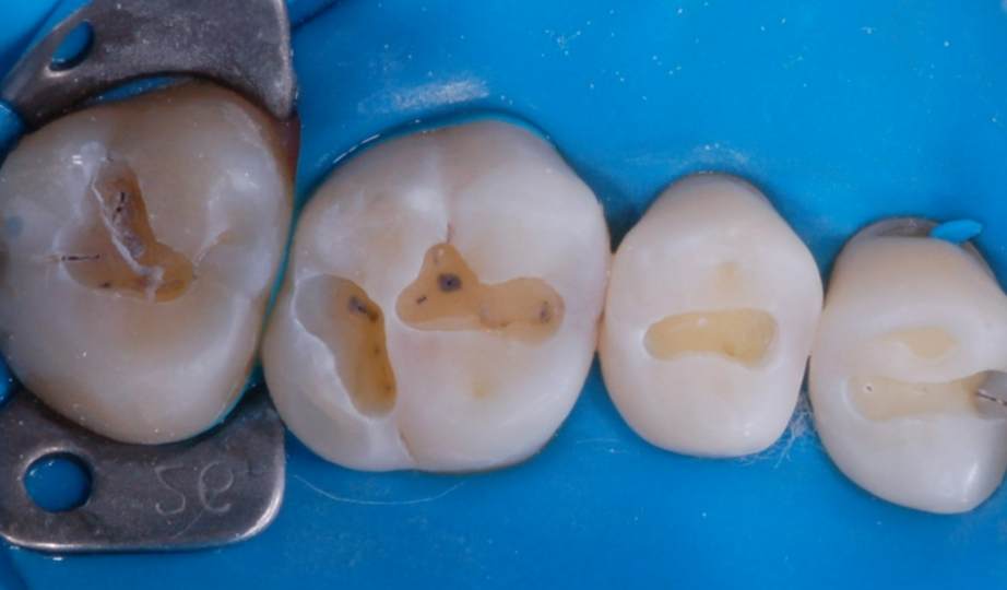 Antes – Resina Posterior