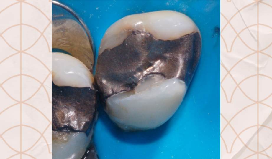 Foto AntesTratamento envelhecimento precoce dos dentes -  site Dra Fernanda Mollica - Soluções Odontológicas em São José dos Campos e Vale do Paraíba