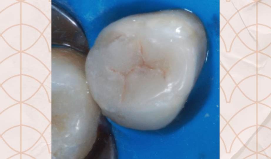 Foto DepoisTratamento envelhecimento precoce dos dentes -  site Dra Fernanda Mollica - Soluções Odontológicas em São José dos Campos e Vale do Paraíba