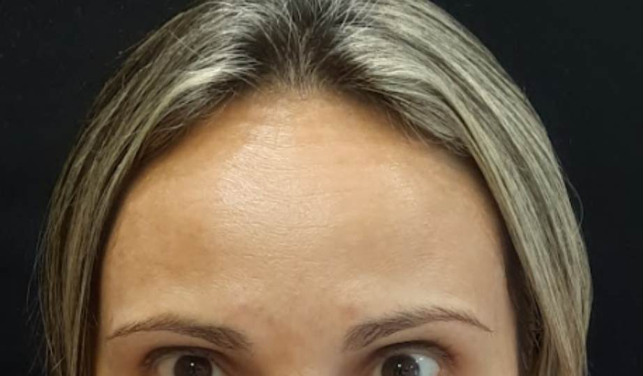 Foto Depois Harmonização facial-  site Dra Fernanda Mollica - Soluções Odontológicas em São José dos Campos e Vale do Paraíba