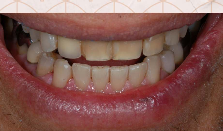 Foto antes Facetas Cerâmicas -  site Dra Fernanda Mollica - Soluções Odontológicas em São José dos Campos e Vale do Paraíba