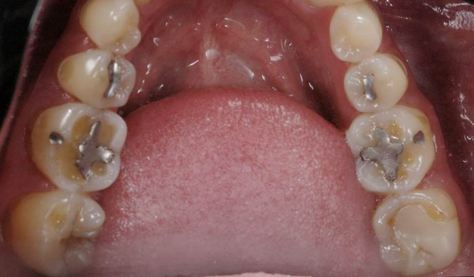 Foto AntesTratamento envelhecimento precoce dos dentes -  site Dra Fernanda Mollica - Soluções Odontológicas em São José dos Campos e Vale do Paraíba