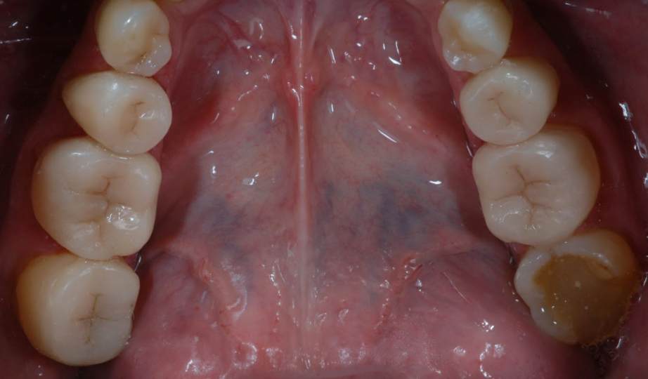 Foto DepoisTratamento envelhecimento precoce dos dentes -  site Dra Fernanda Mollica - Soluções Odontológicas em São José dos Campos e Vale do Paraíba